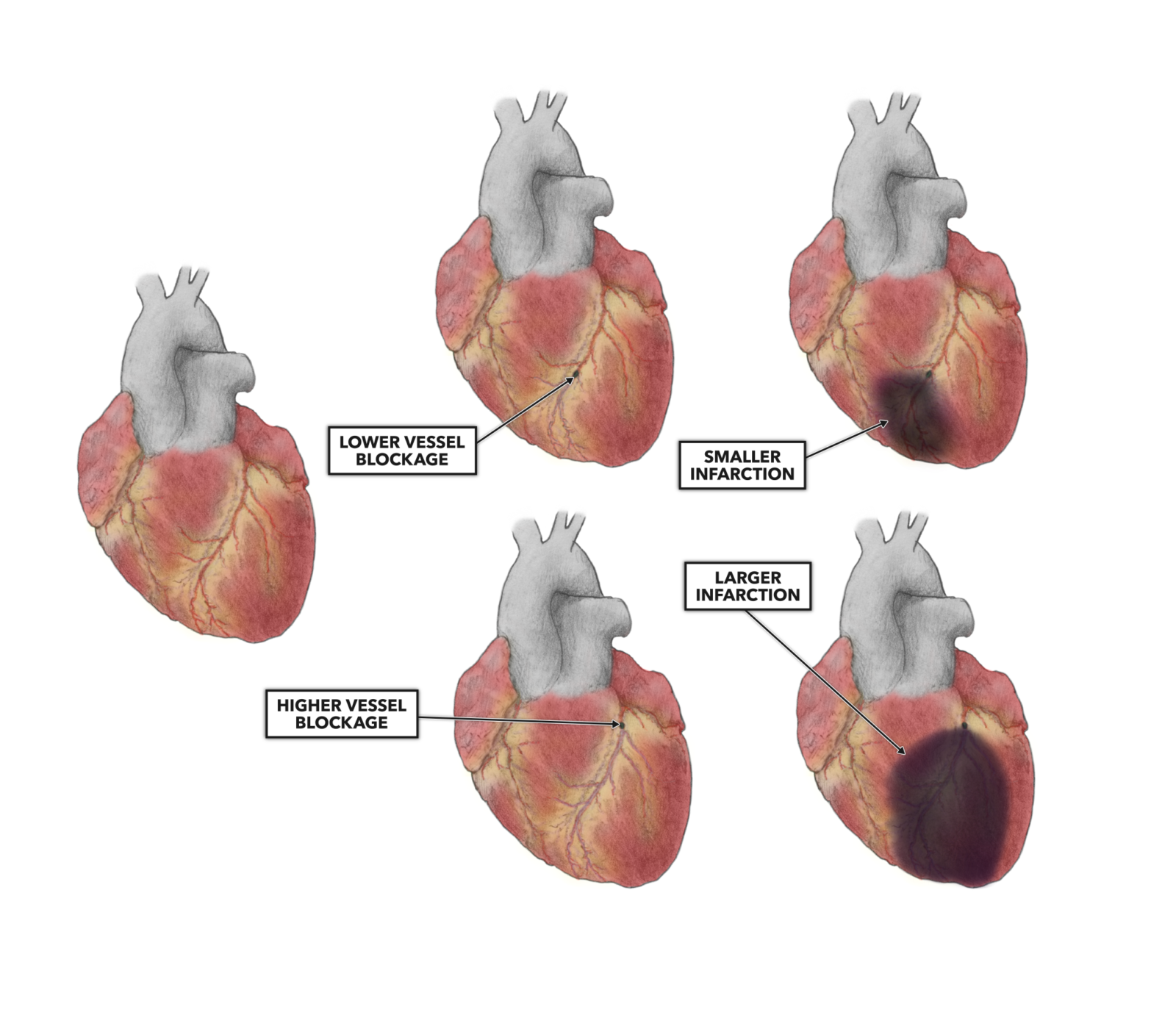 CrossFit The Heart Part 10 Myocardial Infarction