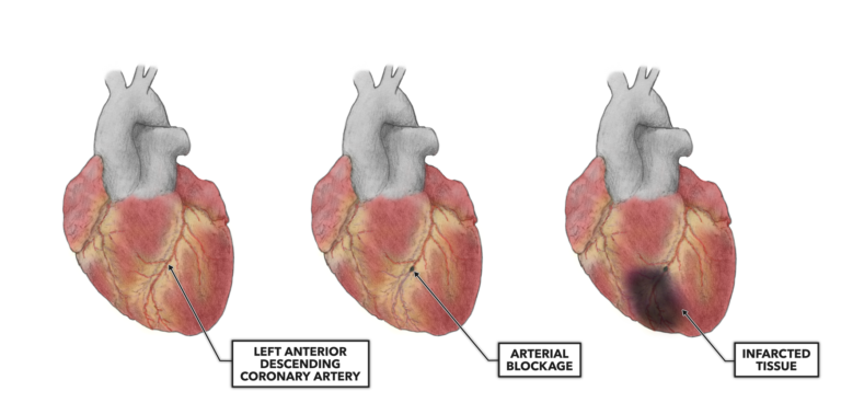 CrossFit The Heart Part 10 Myocardial Infarction