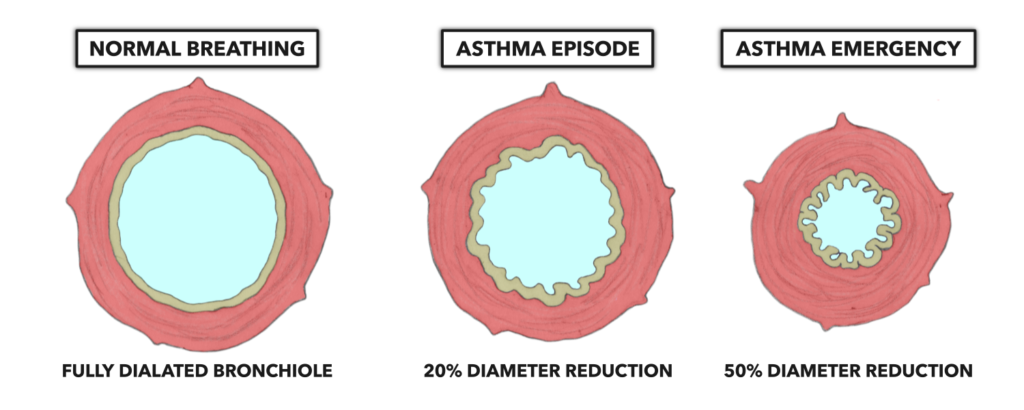 CrossFit | Lung Anatomy and Physiology: Asthma