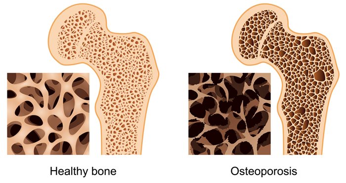 image of healthy vs osteoarthritis bone